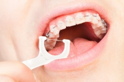 Orange County Dentist ceramic clear braces