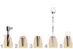 Tooth Implant Cost